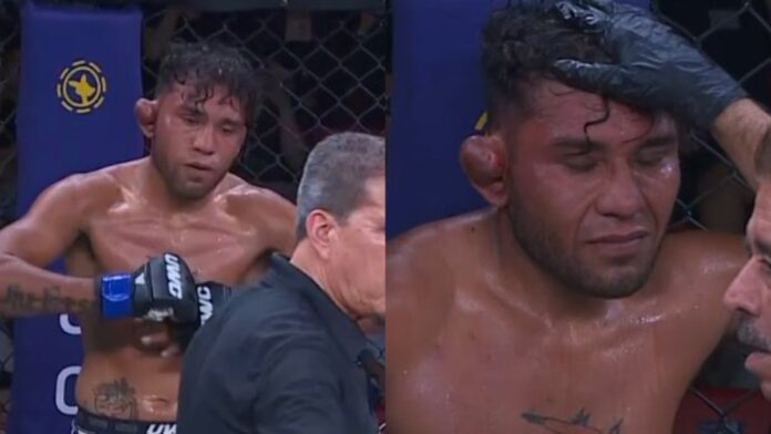 The cauliflower ear of JosÃ© PeÃ±aloza became severely damaged during a video of his fight at UWC 43, resulting in the fight being stopped.